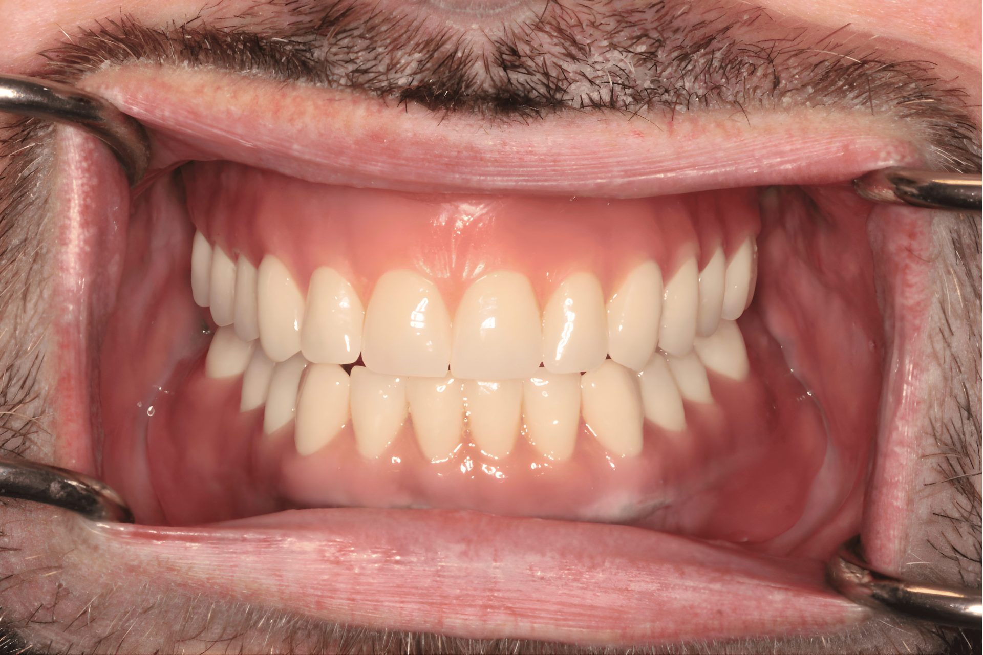After Photo of upper and lower implant supported denture completed by Merrimack Smiles Family, Esthetic and Reconstructive Dentistry, Merrimack NH, 03054