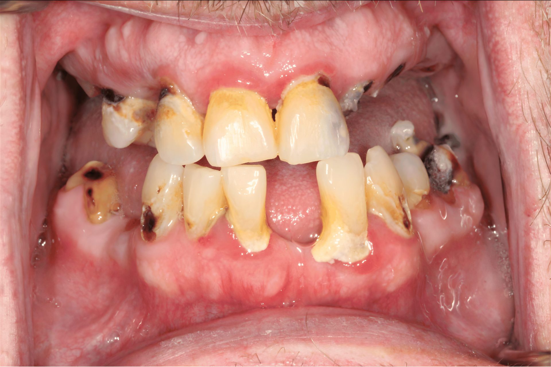 Before Photo of upper and lower implant supported denture completed by Merrimack Smiles Family, Esthetic and Reconstructive Dentistry, Merrimack NH, 03054